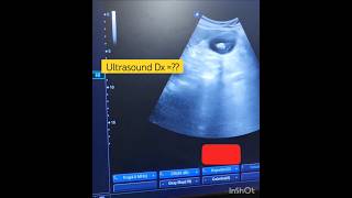 Ultrasound shortsshortvideoclipgallbladdercholelithiasis [upl. by Nicholas]