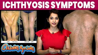 Ichthyosis நோய்யின் Symptoms இது தான்  Remedies For Ichthyosis  Pen Nalan  IBC Mangai [upl. by Yeaton]