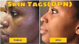 BEFORE AND AFTER DERMATOSIS PAPULOSA NIGRA REMOVAL RESULTS IN 1 WEEK  VIDEO  PHOTOS INCL [upl. by Siver]