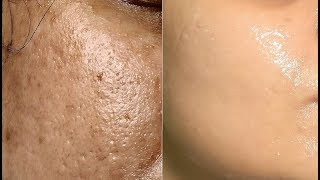 How to get rid of Large OPEN PORES with ice cubes massage [upl. by Tcideneb]