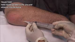 Olecranon Bursitis  Aspiration and Injection  In Vivo Series [upl. by Solnit]