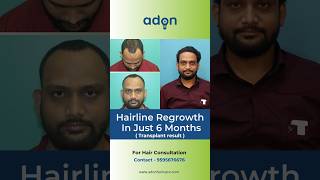 3000 grafts hair transplant result in 6 months  Best hair line  Adon Hair Care viralvideo [upl. by Nobie948]