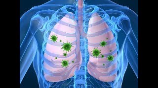 8 síntomas de la pulmonía que no puedes ignorar [upl. by Kahaleel61]