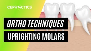 Up righting molars in Orthodontics [upl. by Godfry]