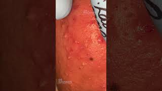 Deep Blackhead Removal by DrLalit Kasana Part 3  Goldmine of Blackheads [upl. by Riamu]