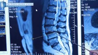 Degenerative Spondylolisthesis by Dr Tony Mork [upl. by Tien]