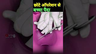 छोटे ऑपरेशन से बच्चा पैदा episiotomy delivery normaldeliverytips [upl. by Sivrahc]