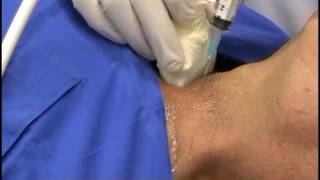 Agoaspirato Tiroideo  Fine Needle AgoBiopsy [upl. by Savadove]