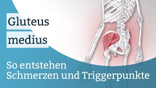 Gluteus medius Schmerzen Triggerpunkte und deren Aktivierung [upl. by Gardie856]