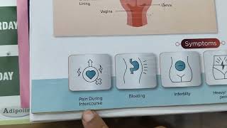 Endometriosis the most common cause of painful periods [upl. by Norrad]