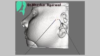 Computer Guided Temporomandibular Joint Arthrocentesis TMJ Pain Treatment [upl. by Eiramlatsyrc]