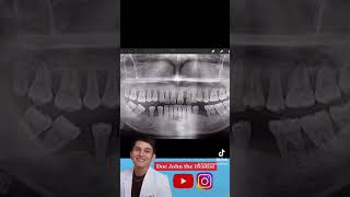 SEVERE Bone Loss  Periodontitis  Gumagalaw na ngipin [upl. by Ellis]