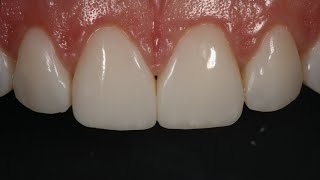 Resin Veneering and Freehand Diastema Closure [upl. by Akciret851]