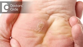 What causes of warts on hands and feet  Dr Urmila Nischal [upl. by Yensehc]