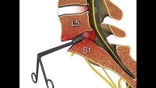 Top 10 5 Dos and 5Donts of microdisectomy laminectomy L5S1 surgery Recovery and success story [upl. by Lewan]