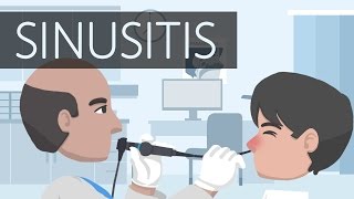 What is Sinusitis [upl. by Alika]