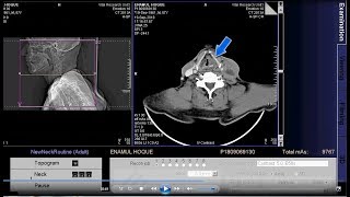 CT scan of larynx and hypopharynx Neck format [upl. by Clotilde]