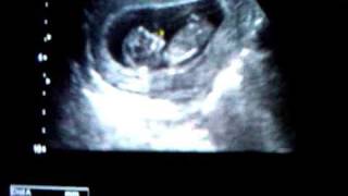 115 week ultrasound [upl. by Atazroglam]