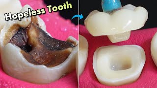 IMPOSSIBLE Restoration Of Tooth Caries  Amazing Before And After [upl. by Aynnek]