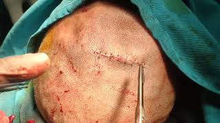 Scalp lipoma by Dr Mohamed Elshamaa [upl. by Diva]