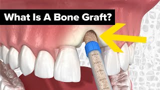 Dental Bone Grafts Explained [upl. by Gerrilee]