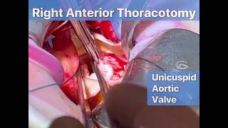 Right anterior thoracotomy AVR  Supracoronary Ao replacement [upl. by Shiri953]