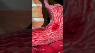 What Can Cause Stomach Ulcers Animation [upl. by Inittirb]