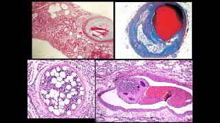 Patología General  Patología Vascular 11 [upl. by Leelaj]