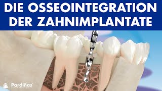 Die Osseointegration der Zahnimplantate © [upl. by Jesse704]