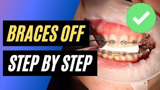 BRACES OFF  Step by step orthodontic removal [upl. by Rehpotsrik826]