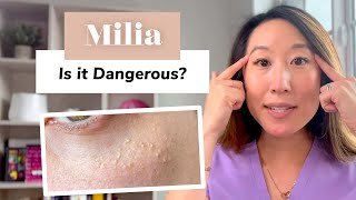 What Is Milia Removal and Prevention  Dermatologist Guide [upl. by Tersina379]