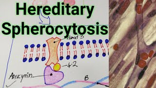 Hereditary SpherocytosisPathogenesisClinical featuresDiagnosis TreatmentMBBS Nursing [upl. by Ardnalahs]