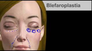 Blefaroplastia Inferior com Preenchimento Facial  Antes e Depois Cirurgia Plástica [upl. by Enoval]