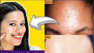 How to get rid of Tiny Bumps  Milia on Forehead  Face Quickly Naturally [upl. by Leonanie]