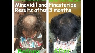 Minoxidil and Finasteride Results after 3 Months Usage [upl. by Cimbura]