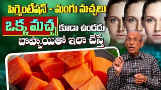 ఇలా చేస్తే మంగు మచ్చలు ఇంకా ఉండవ్  Natural Tip for Dark Spots on Face  Get Rid of Pigmentation [upl. by Yenot]