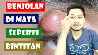 Benjolan Di mata Seperti Bintitan [upl. by Gertruda]