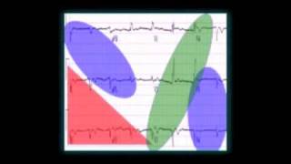 The 12 Lead EKG What Leads Look Where [upl. by Alexine]