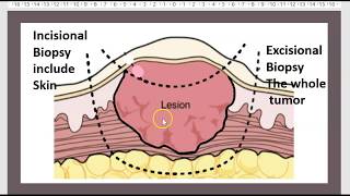 3 minutes Benign breast tumor Papilloma Fibroadenoma Lump Biopsy Excision Cyst USMLE NCLEX [upl. by Colburn]