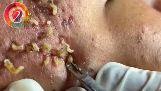 Ultimate Pimple Popping 2024 Satisfying Blackhead Extractions amp Acne Solutions [upl. by Thistle288]