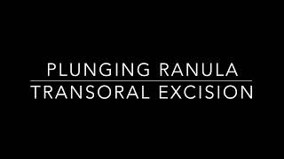 Plunging ranula surgery [upl. by Warren]