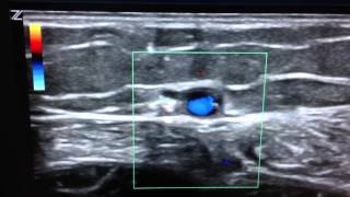 Ultrasound of Incompetent Short Saphenous IMG 0056 Scarless Vein Care by Dr Kamran [upl. by Elodea]