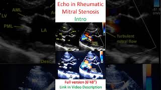 Echocardiogram in Rheumatic Mitral Stenosis [upl. by Odanref]