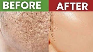 How To Get Rid Of Acne Scars COMPLETELY [upl. by Anyar]