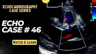 Echo Case 46 Echocardiography Spot Diagnosis Series  Cardiology [upl. by Boothe]