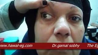 Third Nerve Palsy  شلل العصب الثالث [upl. by Aziram927]