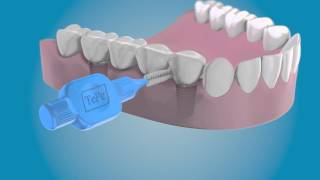 Clean the sides of your dental implants with a TePe Interdental Brush [upl. by Giles]