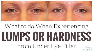 What to do When Experiencing Lumps or Hardness from Under Eye Filler [upl. by Ellatsyrc]