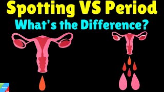 What is the difference between Spotting and Period – Spotting VS Period [upl. by Donny244]