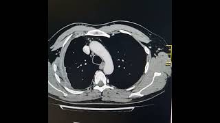 Small hydropneumothorax on right side with pleural cortication [upl. by Ehsiom]